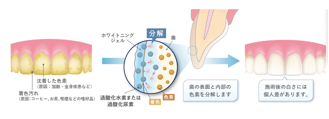歯が白くなるメカニズム